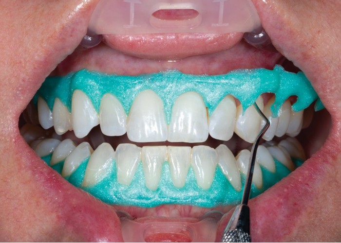 Ultradent - λευκανση - δοντια - OpalDam Green Μεμονωμένες Σύριγγες OpalDam - Ρητινώδες υλικό προστασίας 